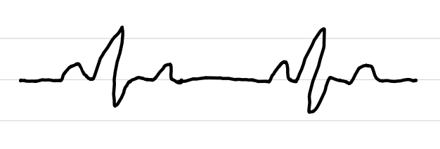 <ul><li><p>rate: <span style="color: red;"><60 bpm</span></p></li><li><p>rhythm: regular</p></li><li><p>P waves: normal</p></li><li><p>PR interval: 0.12-0.20 sec</p></li><li><p>QRS complexes: <0.10 sec</p></li><li><p>ST segments: normal</p></li></ul><p></p>