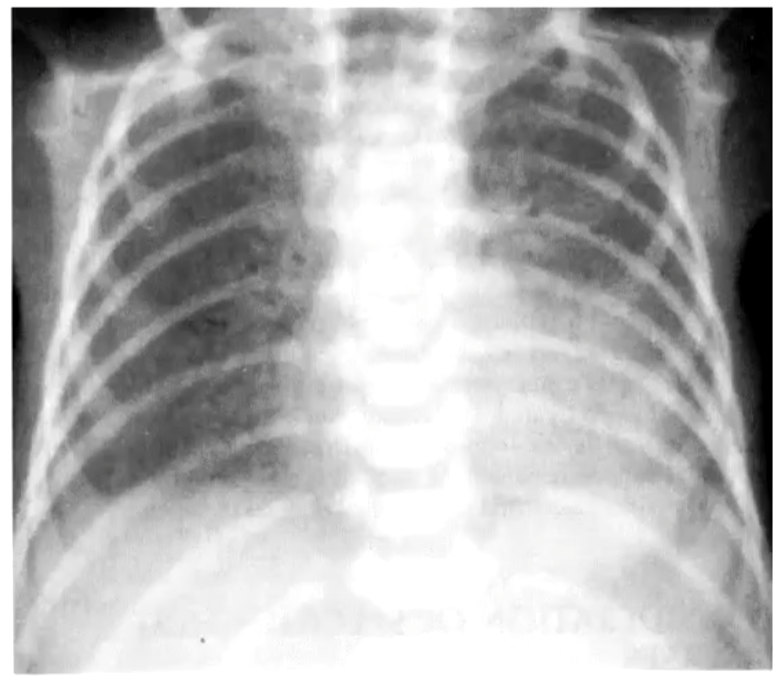 No hard outline, left diaphragm is barely visible