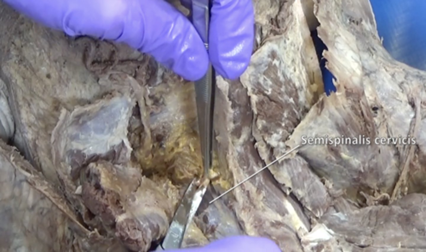 <p>deep to the Semispinalis capitis muscle and superiorly attaches to the spinous process of the axis (C2)</p>
