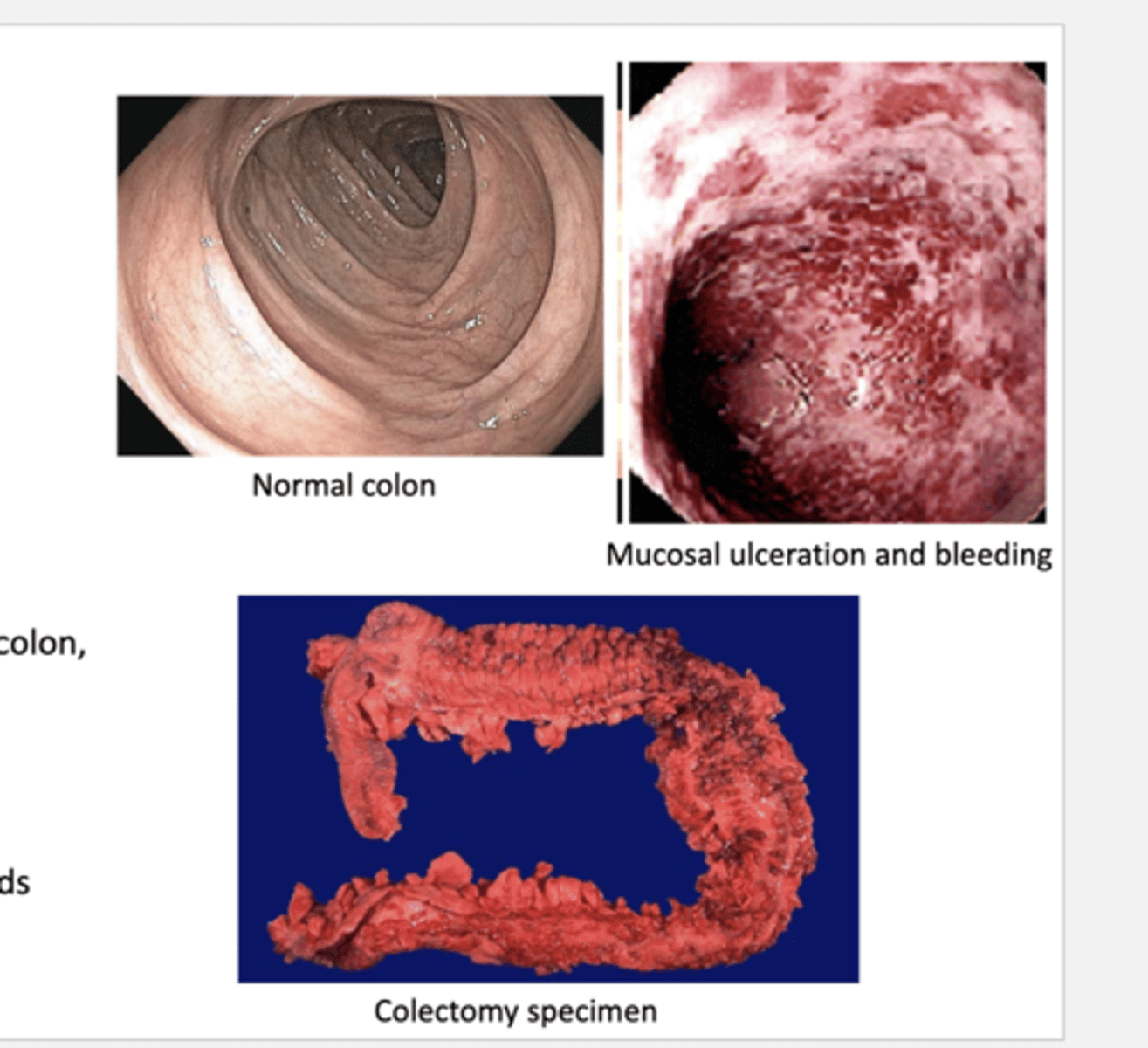 <p>inflammatory bowel disease characterized by bouts of bloody diarrhea</p><p>-often bloody mucosal ulceration of the colon.</p><p>-anemia common</p><p>-oral manifestations</p><p>&gt;pyostomatis vegetans--&gt; low occurence but more common here than in crohn's disease</p><p>&gt;RAS-like ulceration</p><p>&gt;angular cheilitis</p><p>&gt;atrophic glossitis</p><p>&gt;other anemia findings</p>