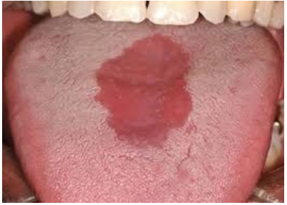 <p>What lesion is this?</p>