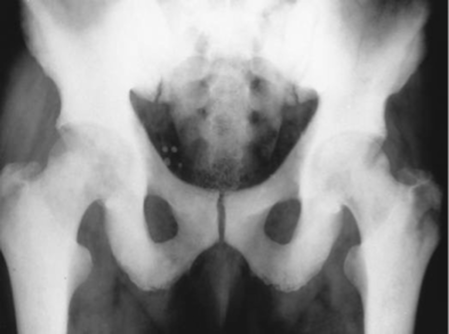 <p>ID pelvic osteoblastic pattern</p>