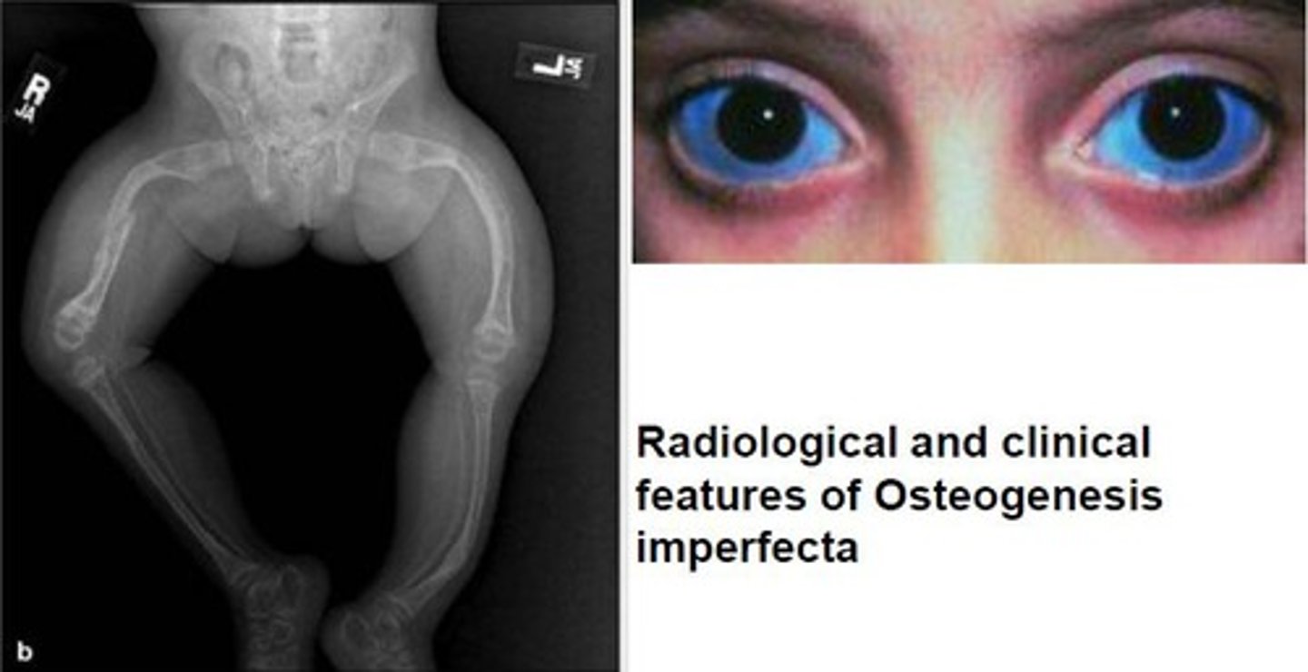 <p>-multiple bone fractures (fragile bones and deformities)</p><p>-blue sclera</p><p>-early hearing loss</p><p>-small, discolored teeth</p><p>**multiple stages of bone healing can often be mistaken for abuse before diagnosed**</p>