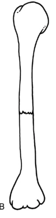 <p><strong>Which fracture?</strong></p>