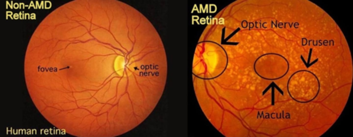 <p><span><u>Definition</u></span>: The leading cause of permanent visual loss in the older population, usually affecting both eyes</p><p><span><u>S&amp;S:</u></span> hazy vision, difficulty seeing when going from bright to low light, blank or blurry spot in central vision, drusen on exam, no pain, no redness</p><p><span><u>Risk Factors</u></span>: Age &gt;50, smoking, obesity, DM, eye trauma, genetic, HTN, farsightedness, light iris color</p><p><span><u>Complications</u></span>: blindness</p><p><span><u>Tx &amp; Management</u></span>: May be reduced by oral Tx with: antioxidants <strong>Vit. C &amp; E</strong>, minerals <strong>Zn &amp; Cu</strong>, carotenoids: <strong>Lutein &amp; Zeaxanthin</strong> from vegetables</p><p>Pharmacological: <strong>Ranibizumab (Lucentis</strong>) - blocks growth of abnormal blood vessels in the back of the eye, injected directly into the eye</p>