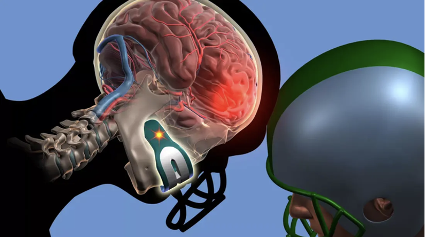 <p>Temporary loss of neuronic function with no apparent structure damage to brain; <em>known as a mild TBI</em>.</p><ul><li><p>Result of blunt trauma from acceleration-deceleration force, direct blow, or blast injury.</p></li><li><p>Location may affect presentation.</p></li><li><p><strong>Repeated concussive incidents</strong> →<strong> <mark data-color="yellow" style="background-color: yellow; color: inherit">Chronic Traumatic Encephalopathy (CTE)</mark></strong></p><ul><li><p><span>Frontal lobe injury → abnormal behavior</span></p></li><li><p><span>Temporal lobe → amnesia or disorientation</span></p></li></ul></li><li><p><strong><u>Watch Out For</u></strong>:</p><ul><li><p>Decreased level of consciousness</p></li><li><p>Worsening headache</p></li><li><p>Dizziness</p></li><li><p>Seizures</p></li><li><p>Abnormal pupil response</p></li><li><p>Vomiting</p></li><li><p>Irritability</p></li><li><p>Slurred speech</p></li><li><p>Numbness</p></li><li><p>Weakness in arms or legs</p></li></ul></li><li><p><strong><u>Medical Management</u></strong>:</p><ul><li><p>Physical and neurological assessments</p></li><li><p>Admission to inpatient floor for observation</p></li><li><p>CT, MRI</p></li><li><p>PET</p></li><li><p>C-Collar/C-Spine precautions</p></li><li><p><strong>Goal</strong>: to preserve brain homeostasis and prevent any secondary brain injury</p></li></ul></li></ul><p></p>