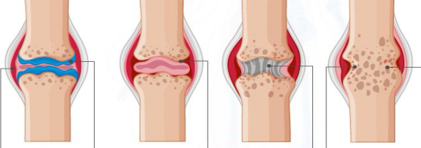 <p><strong>Stages of Rheumatoid Arthritis</strong></p><ol><li><p>____________ → synovial membrane inflamed and thickened, bones and cartilage gradually erode </p></li><li><p>Pannus formation → excessive cartilage loss, exposed and pitted bones </p></li><li><p>Fibrous ___________ → joint invaded by fibrous connective tissue </p></li><li><p>____ ankylosis → bones fused </p></li></ol><p></p>