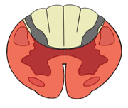 <p>Ischemic injury causing bilateral motor paralysis and loss of pain and temperature with preserved dorsal column function</p>
