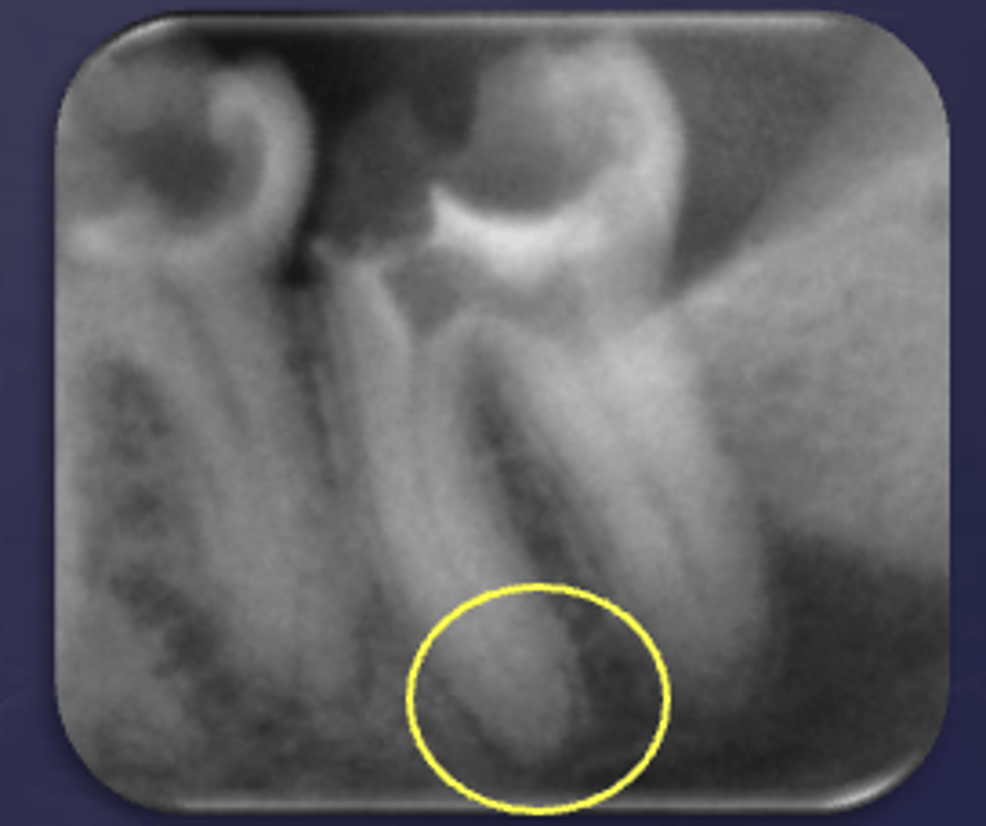<p>What type of change is seen in this radiograph?</p>