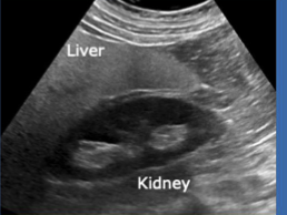 <p>Echogenicity of this </p>