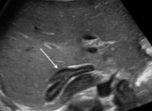 <p>What structure is seen at the white arrow?</p>