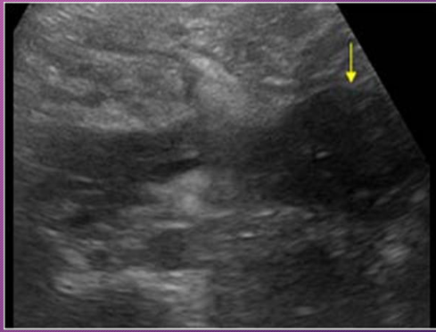 <p>A pancreatic abscess may be ________ or ________</p>
