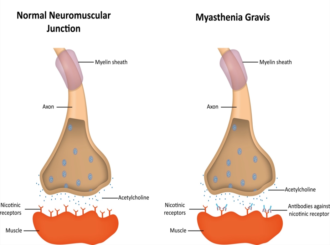 <p>myasthenia gravis</p>