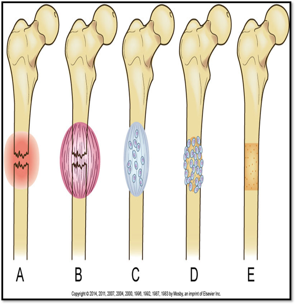 <p><span>•Fracture Hematoma</span></p><p><span>•Granulation Tissue</span></p><p><span>•Callus Formation</span></p><p><span>•Ossification</span></p><p><span>•Consolidation</span></p><p><span>•Remodeling</span></p>