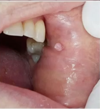 <p>viruses that could causes this lesion </p>