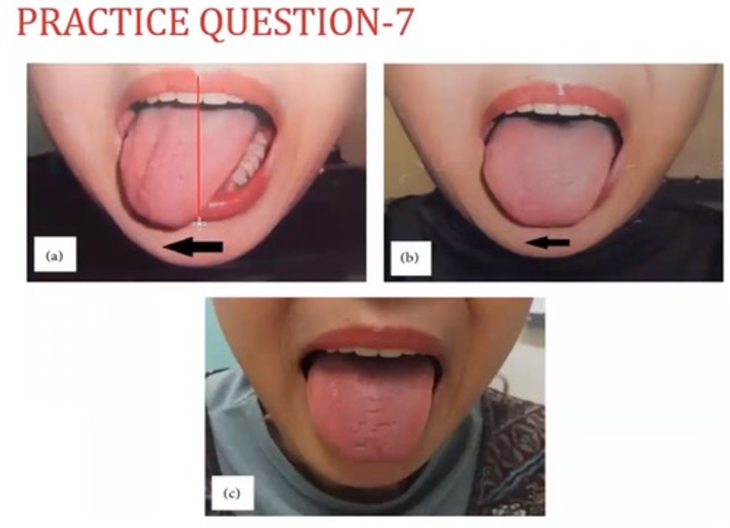 <p>B. right-sided tongue atrophy and deviation toward the right with tongue protrusion</p><p>Lick your Lesion</p>