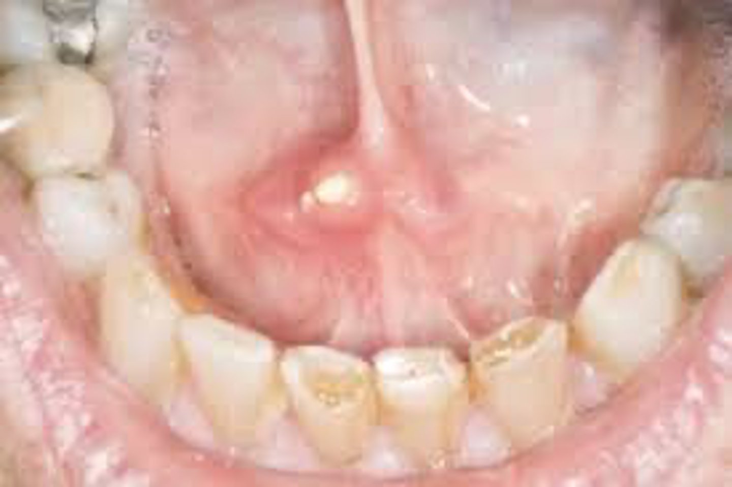 <p>A radiopaque mass is seen in the floor of the mouth near the submandibular duct.</p><p>Which condition is most likely?</p>