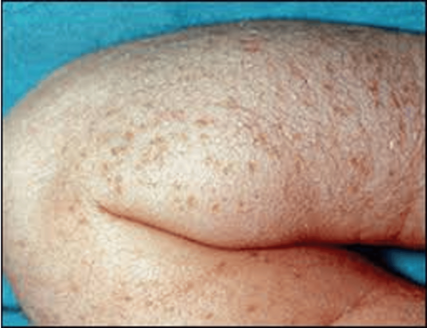 <p>occurs in 5% black newborns and &lt;1% of white newborns</p><p>presents at birth as small vesiculopustular lesions with a brown macular base</p><p>all areas of the body may be affected</p>