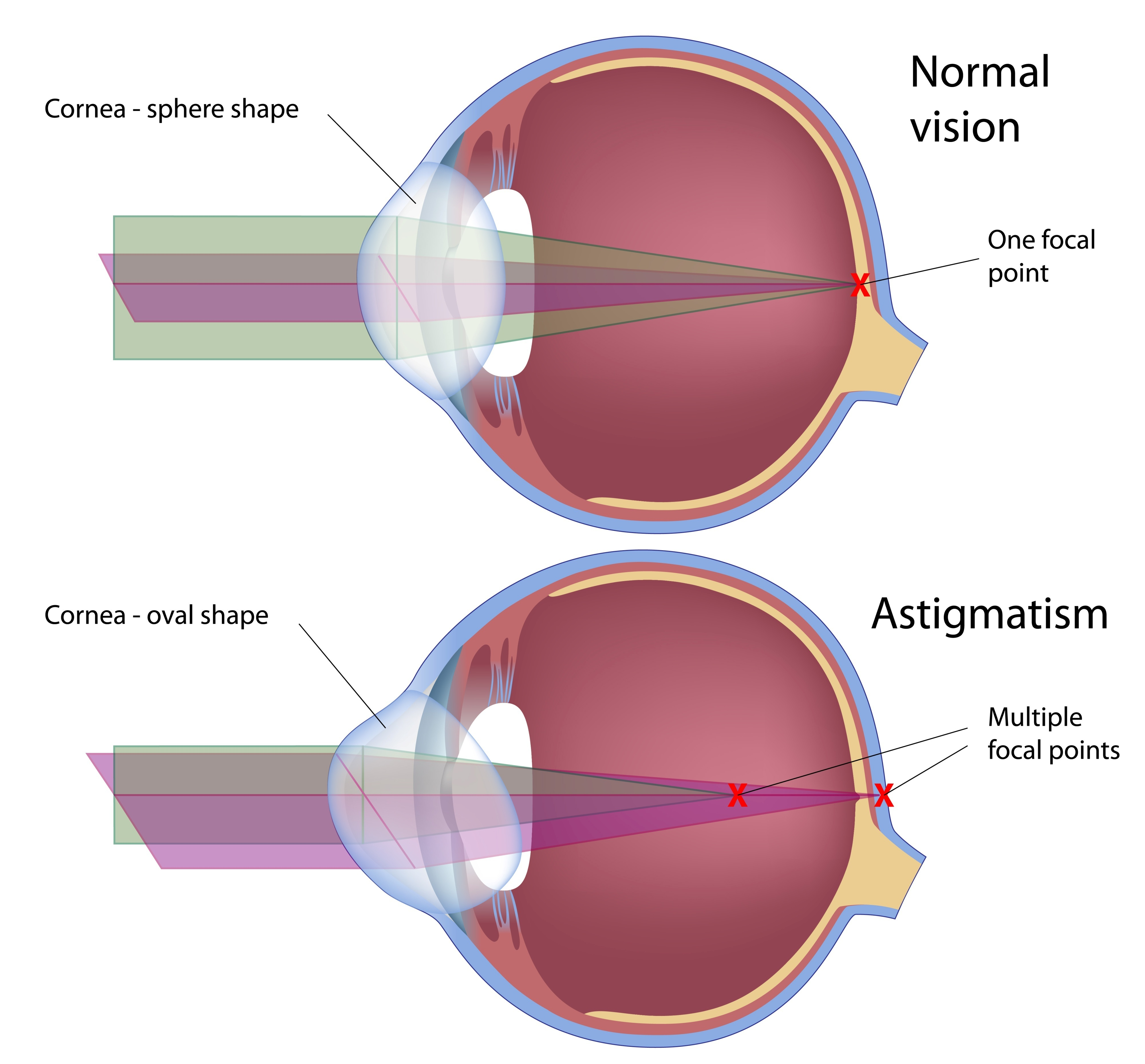 <p>c. There are irregularities in the curvature of the cornea or crystalline lens</p><p></p><p>cornea - transparent front part of eye covering iris, pupil and anterior chamber</p>