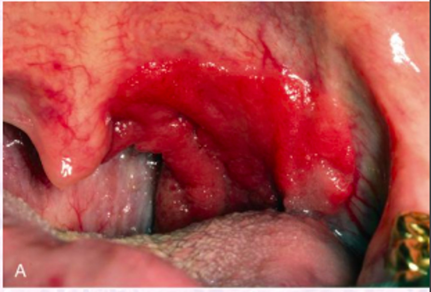<p>Hint: Favored site for HPV-associated carcinomas</p>