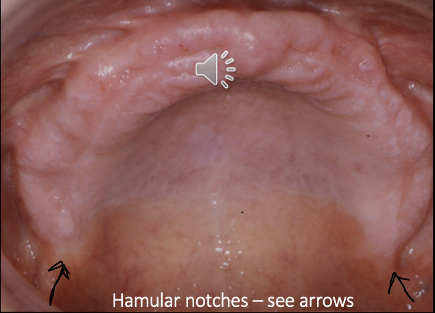 <p>outline the hamular notches </p>