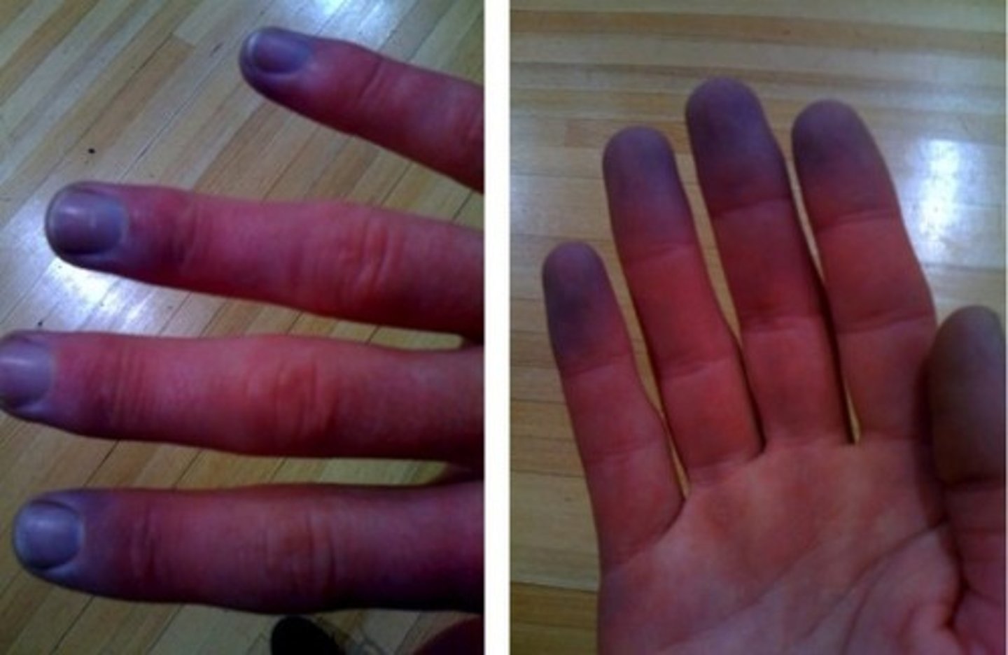 <p>a bluish skin color that results from decreased blood oxygen content</p>