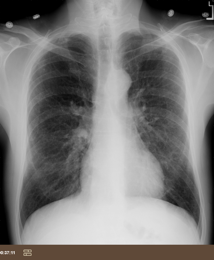 <p>progressively worsening dyspnea over 2 days, former smoker</p>