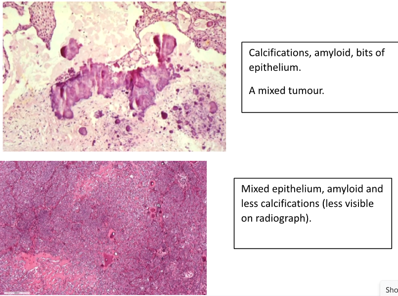 <p>Composed of Pleomorphic Epithelium with Calcifications</p><p>Enamel Matrix Material which may calcify</p><p>Cubodial Cells with Prickles</p>