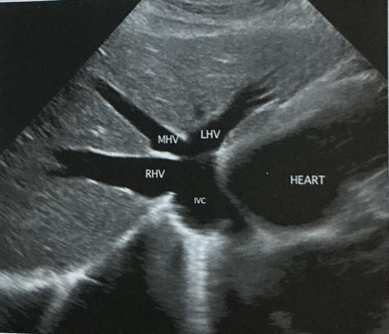 <ul><li><p>Canadian moose sign</p></li><li><p>Dilatation from right heart failure</p></li><li><p>Playboy bunny sign</p></li></ul><p></p>