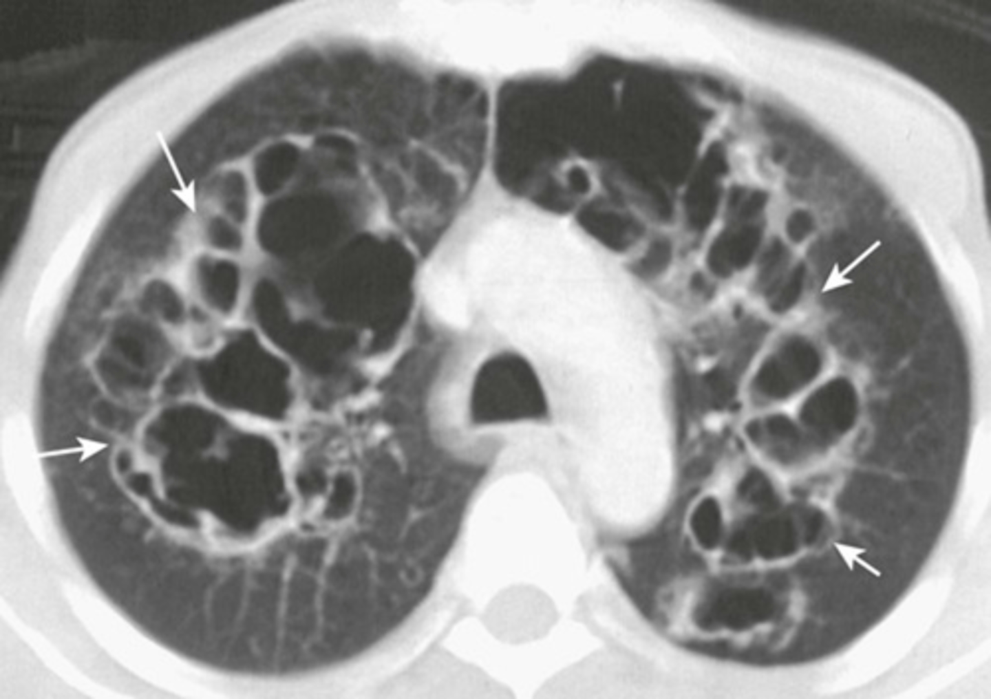 <p>-in lung parenchyma or mediastinum</p><p>-thicker than bulla (<3mm)</p>