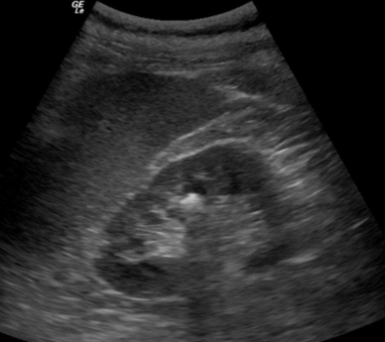 <p>a. Hematuria</p>
