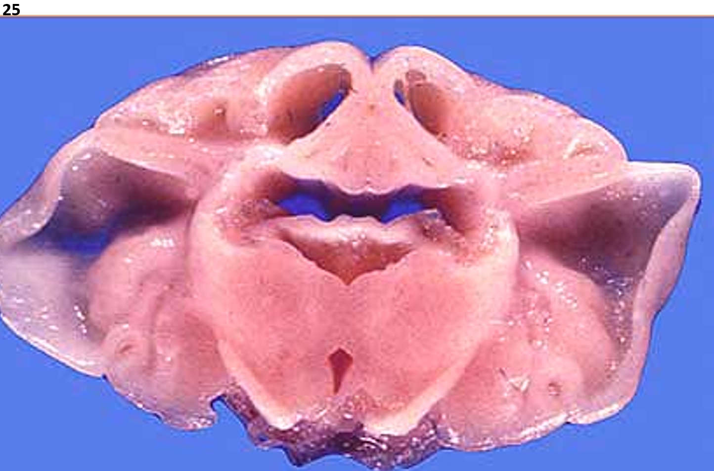 <p>25.<span>&nbsp; </span>Tissue from a neonatal lamb.<span>&nbsp; </span>What is the most likely cause?</p><p class="MsoNormal">a.<span>&nbsp; </span>Ovine pestivirus (in utero infection)</p><p class="MsoNormal">b.<span>&nbsp; </span>Ovine bunyavirus (in utero infection)</p><p class="MsoNormal">c.<span>&nbsp; </span>Copper deficiency (dam)</p><p class="MsoNormal">d.<span>&nbsp; </span>Hypothyroidism<span>&nbsp; </span>(dam)</p>