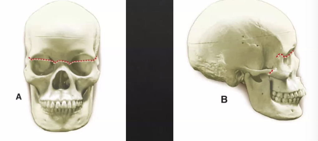 <p>craniofacial disjunction</p><ul><li><p>bone is not stabilized and is mobile</p></li><li><p>face not attached to cranium</p></li><li><p>fracture near orbits</p></li><li><p>least common injury, with extreme force needed to occur</p></li></ul><p></p>