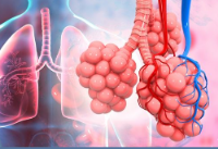 Emphysema
