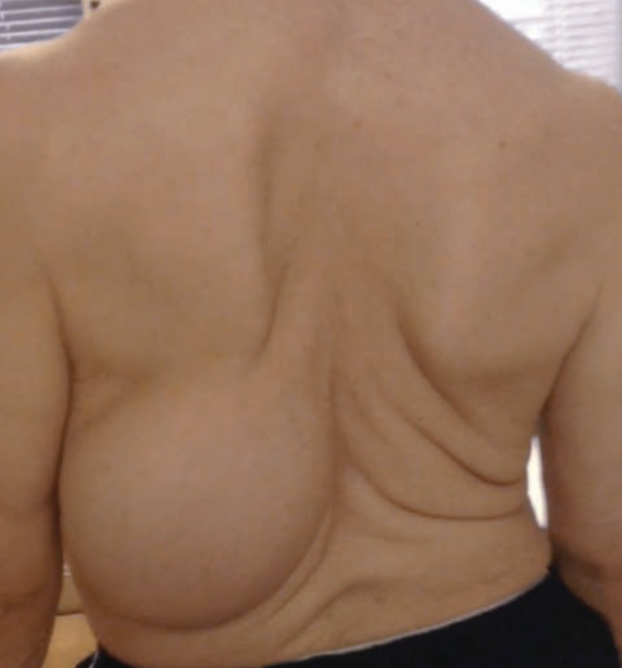 <p>Primary Skin Lesion</p><ul><li><p><strong>Solid mass</strong> of tissue <strong>under dermis</strong> of <strong>more than 1-2cm </strong>but does <strong>not always have sharp borders</strong></p></li><li><p>E.g., large lipoma</p></li></ul><p></p>