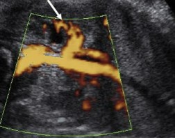 <p>The fetus scanned on has testicular hypoplasia. When the sonographer scanned up to the kidneys, this was seen. What can be assumed here?</p>