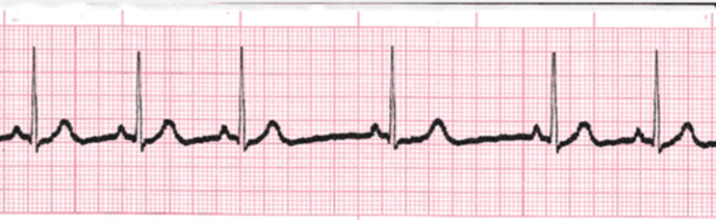<p>Which Arrythmia is this?</p>