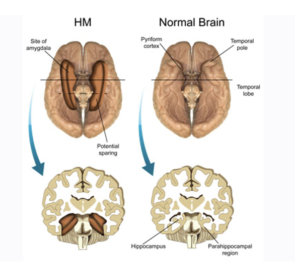 <p>lesion to HM’s brain</p>