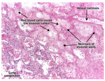 <p>Initial – pulmonary or sinus infection; histopathology – haemorrhagic infarction (tissue death due to blocked blood vessels), necrosis, branching septate hyphae (fungal filaments with cross-walls)<br>Pulmonary – fever, chest pain, cough, hemoptysis (coughing up blood), shortness of breath; chest X-ray/CT – nodules, haemorrhage, cavitation.<br>Sinus – acute facial pain.<br>Dissemination (blood vessel invasion) – necrotic skin lesions, brain abscess (stroke, seizures, altered mental state).</p>