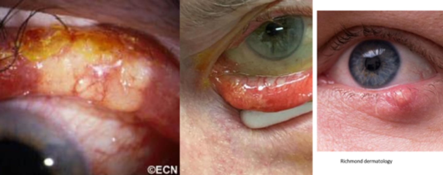 <p>multi-step excision with significant margins as Mohs has a tendency to miss skip lesions seen in intraepithelial spread</p><p>conj map biopsy to determine extent of excision necessary</p><p>lymph node biopsy </p><p>radiation if non-surgical</p>