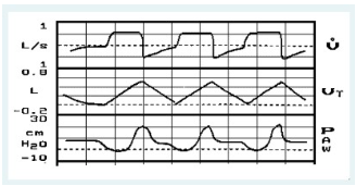 <p>You observe the following graphics display on a patient receiving volume controlled A/C ventilation. The most significant problem is:</p><p>a leak in the patient-ventilator system</p><p>inadequate inspiratory flow setting </p><p>improper sensitivity setting</p><p>presence of auto-PEEP/air-trapping</p>