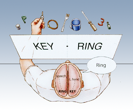 <p><strong>Case study</strong> of patients with <strong>severed corpus callosum </strong>(connects the brain hemispheres, and <strong>sends messages between them</strong>). Study shows specialization in right &amp; left hemispheres.</p><p>Usually only severed to help severe epilepsy.</p>