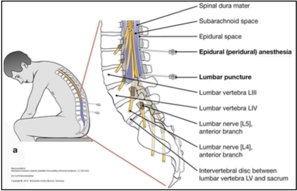 <p>EPIDURAL ANESTHESIA</p>