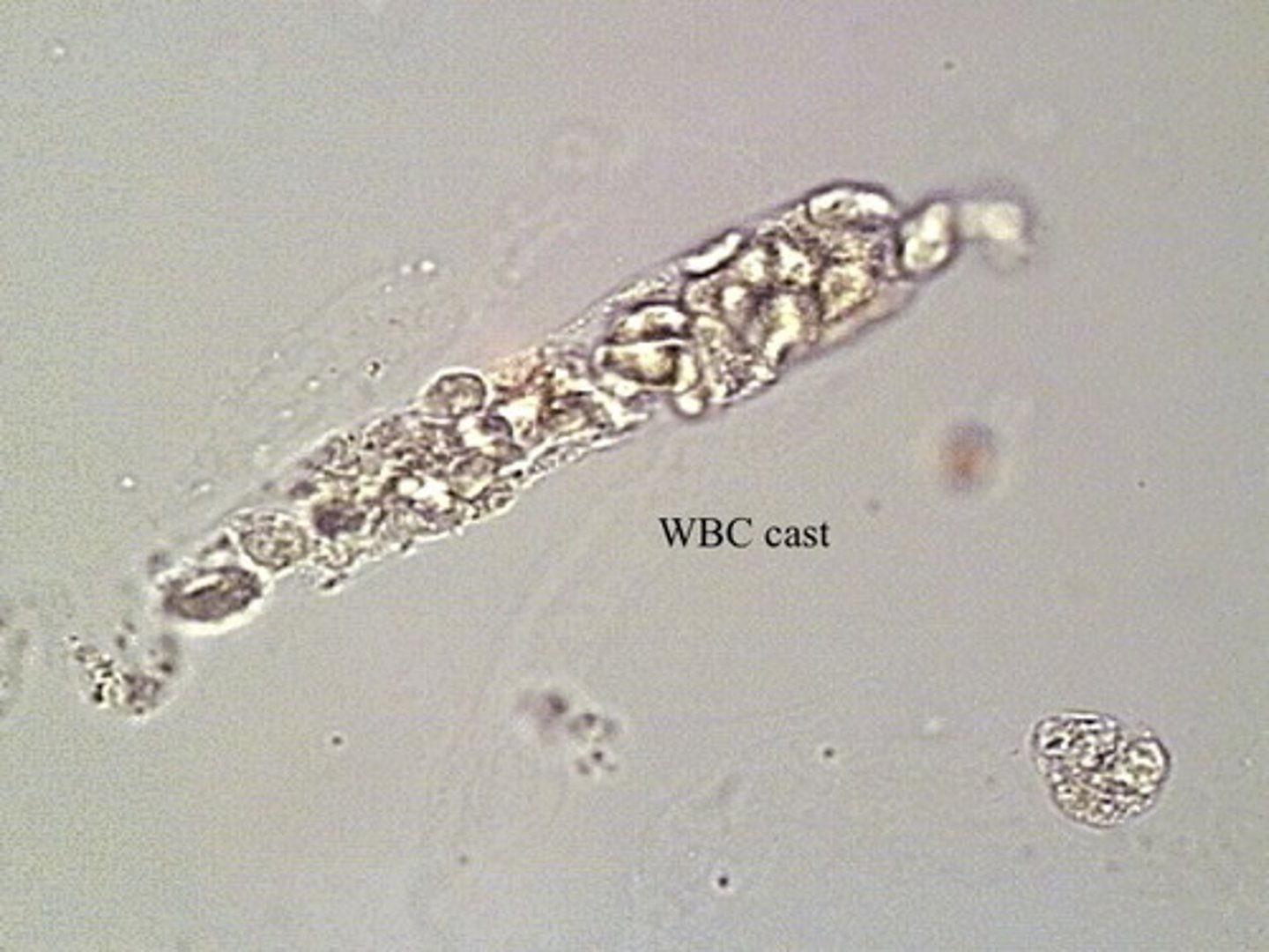 <p>WBC Cast</p><p>-IDs kidneys as site of infection-</p>