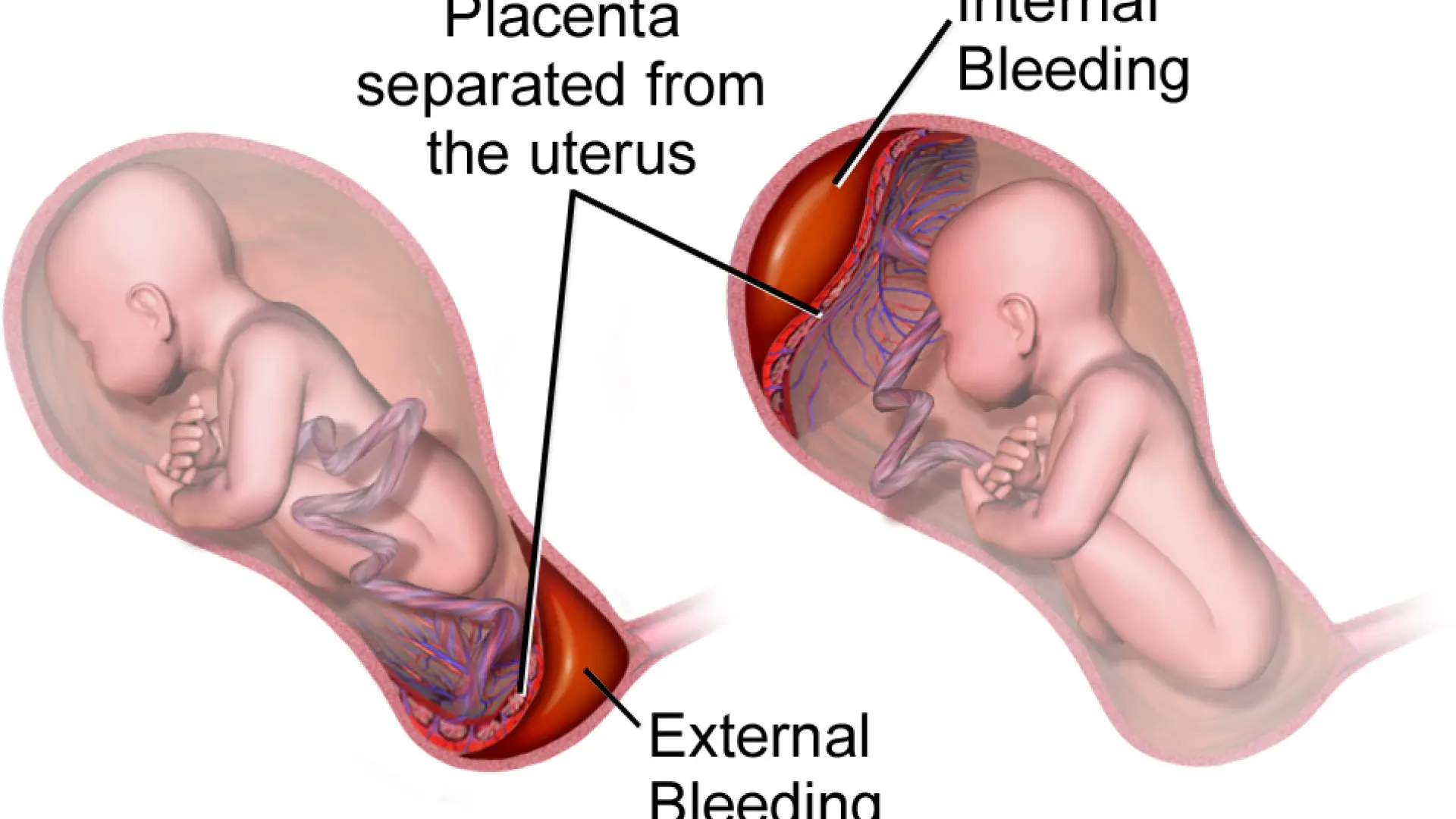 <p>DESPRENDIMIENTO DE PLACENTA </p>