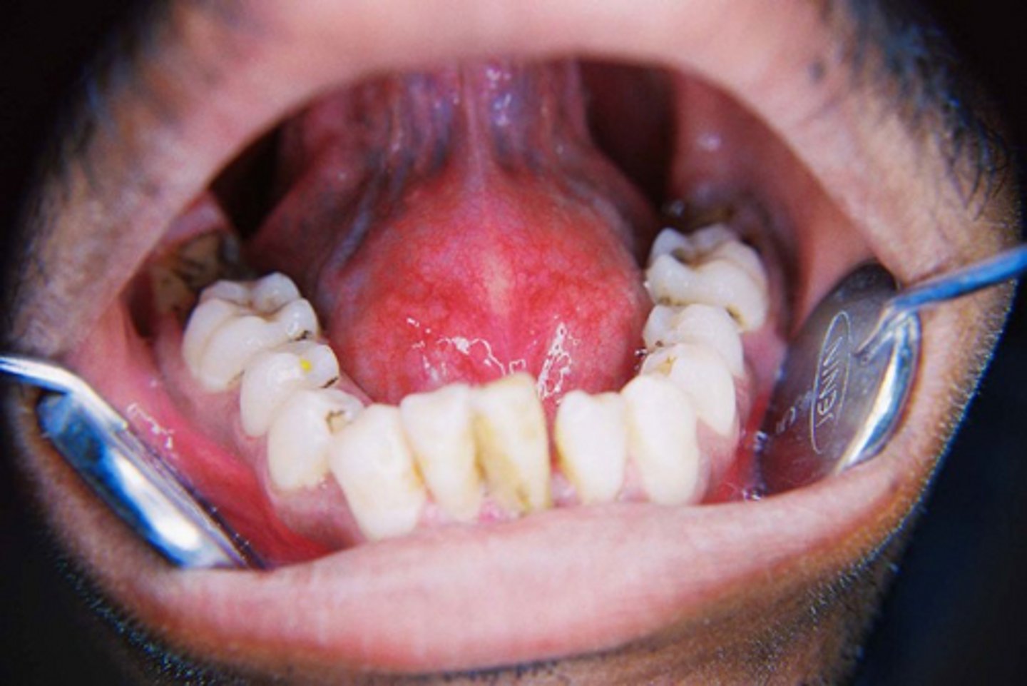 <p>A cyst forms after trauma where epithelial cells are implanted into connective tissue. The lumen contains keratin.</p><p>What is the most likely diagnosis?</p>