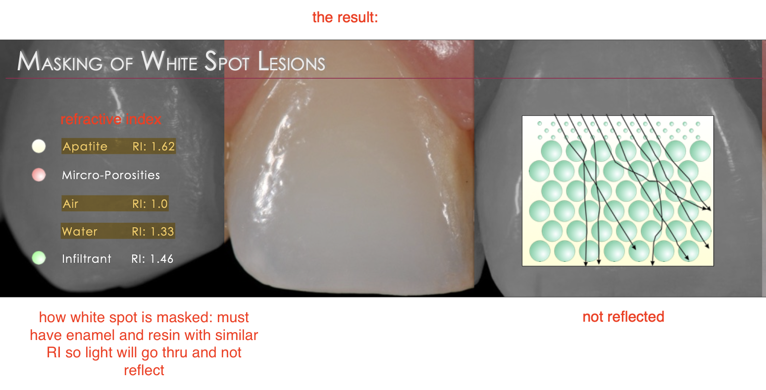 <ul><li><p>how white spot is masked: must have enamel and resin with <strong>similar Refractive Index</strong> so light will go thru and not reflect</p></li><li><p>Apatite RI: 1.62</p><p class="p1">Mircro-Porosities</p><p class="p1">Air RI: 1.0</p><p class="p1">Water RI: 1.33</p><p class="p1">Infiltrant RI: 1.46</p></li></ul><p></p>