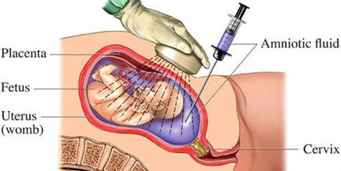 <p>surgical puncture to remove fluid</p>