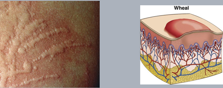 <p>wheal, allergic reaction (hives)</p>