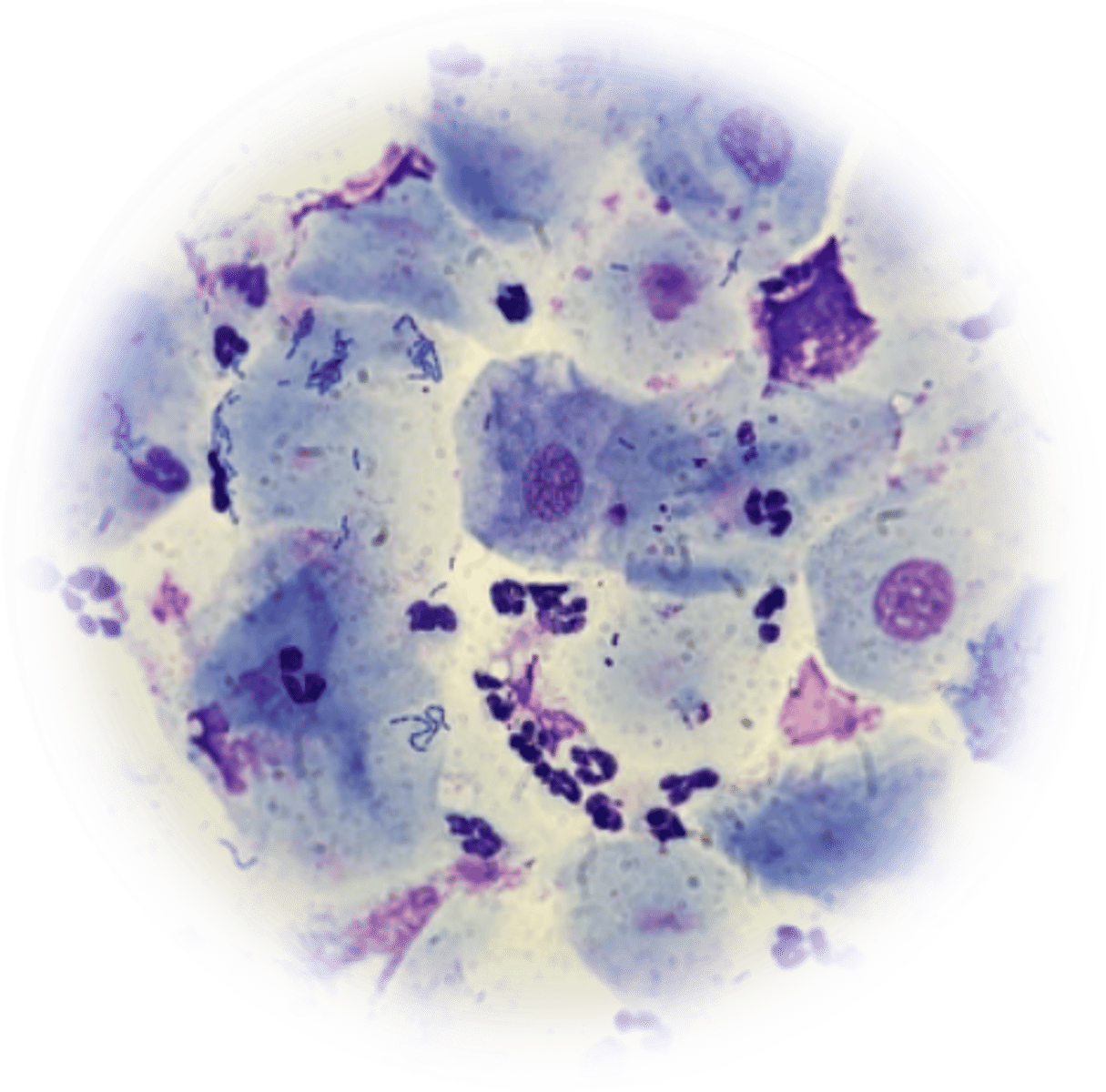 <ul><li><p>Abrupt drop in cornified cells from 100% to 30%</p></li><li><p>Other 70% are parabasal cells &amp; neutrophils</p></li></ul><p></p>